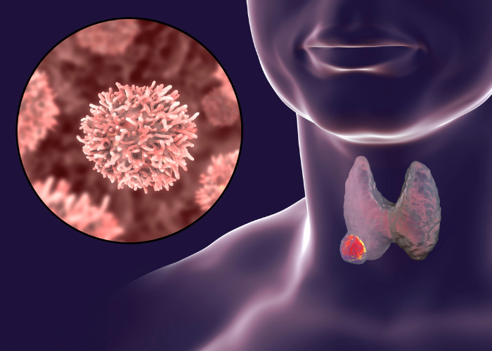 هل تتحول الغدة الدرقية إلى سرطان